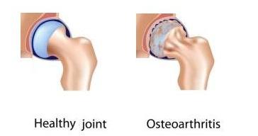 joint osteoarthritis